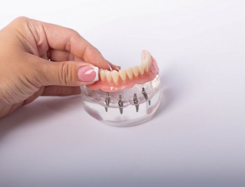 How Many Teeth Do You Get with All-on-4 Dental Implants?