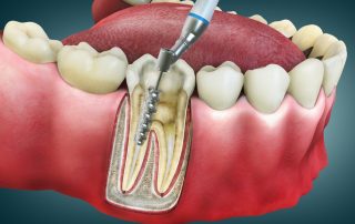 What Is a Root Canal, and Why Might You Need One?