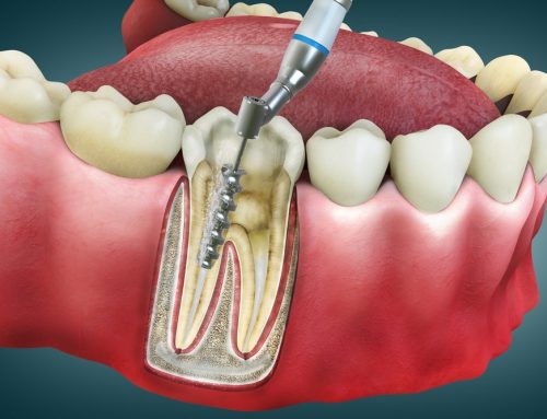 What Is a Root Canal, and Why Might You Need One?