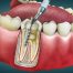 What Is a Root Canal, and Why Might You Need One?