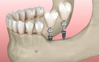 Can You Get All-On-4 Implants with Bone Loss?