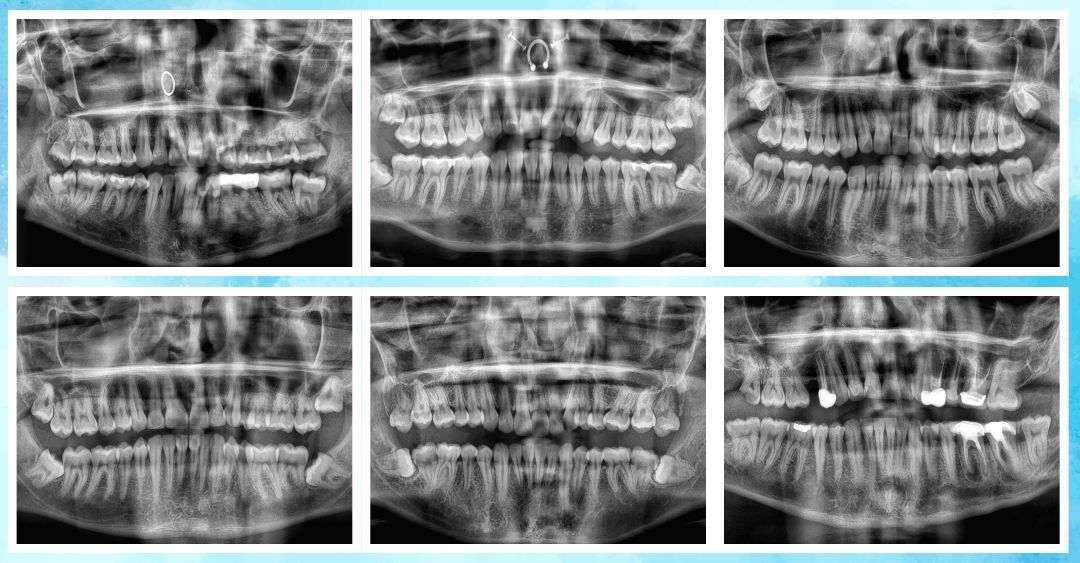 Easing the Hidden Torment of Wisdom Teeth Removal