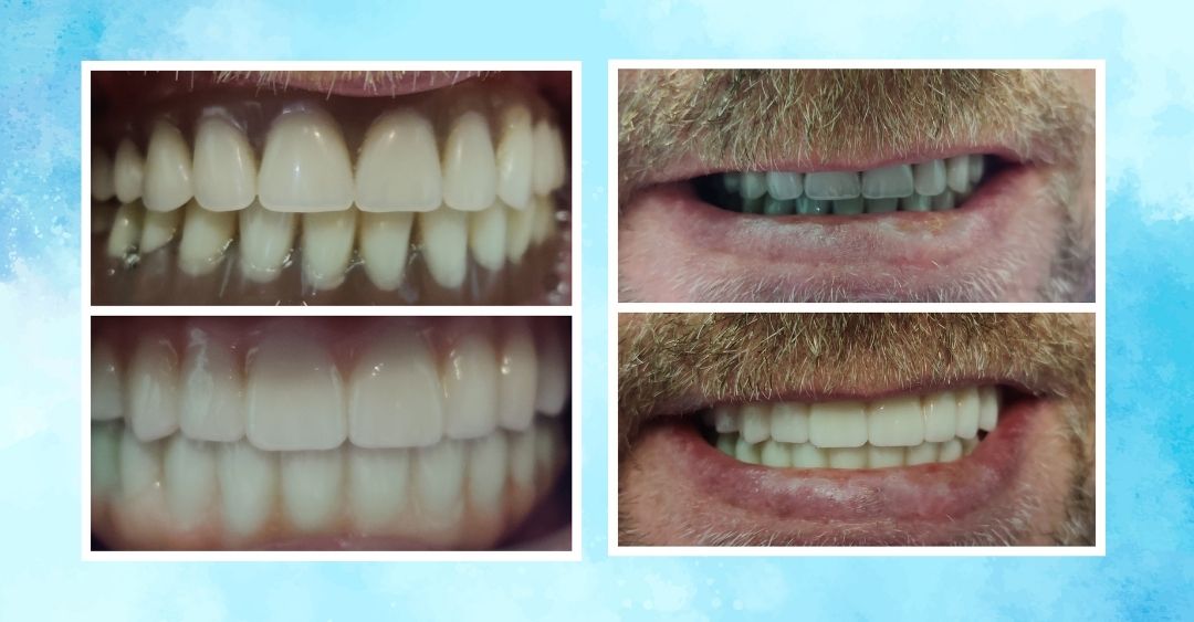 All-on-Four Full Arch Dental Implant Replacement