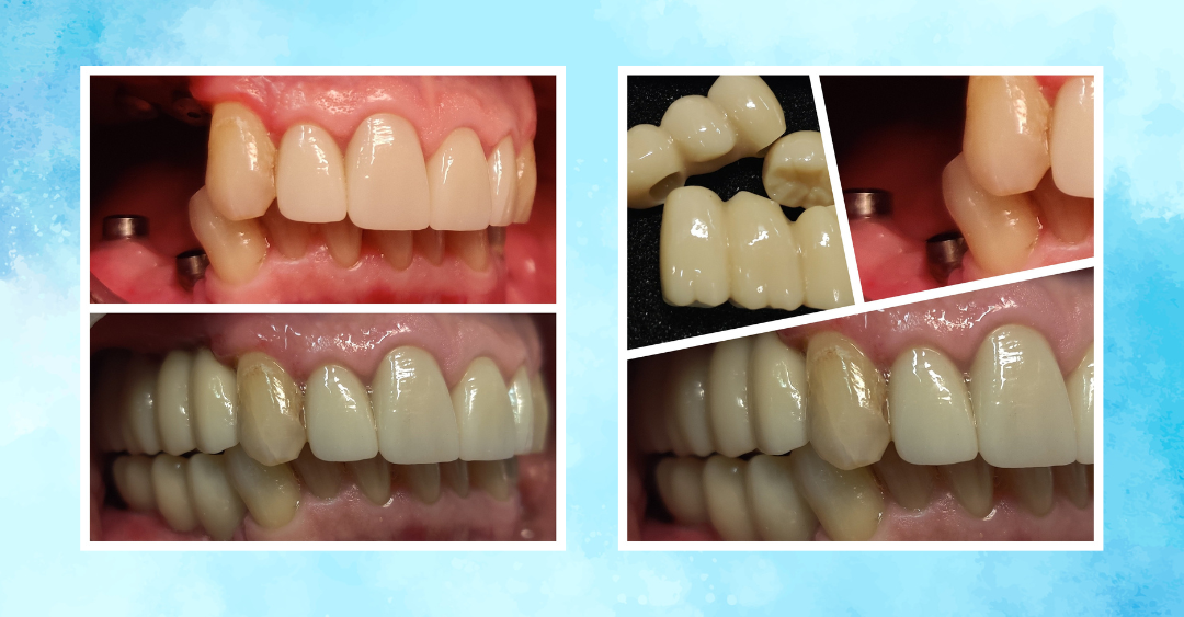 Restoring Function with a Traditional Six-Implant Solution