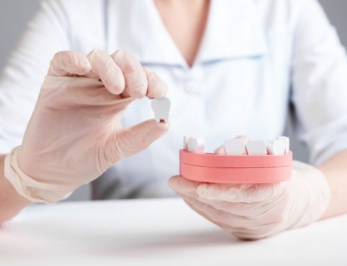 Are Dental Implants the Best Option for Missing Teeth?