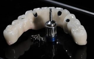 All-On-4 Vs. All-On-6 Dental Implants: Key Differences Explained