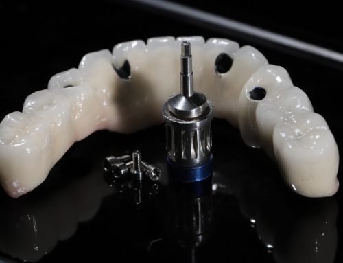 All-On-4 Vs. All-On-6 Dental Implants: Key Differences Explained