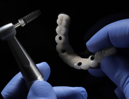 How Many Teeth Are Replaced with All-on-4 Dental Implants?