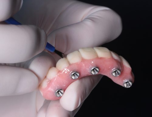 How Long Does the All-on-4 Dental Implant Process Take?