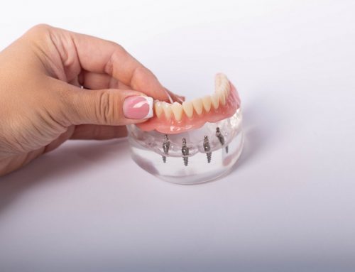 Top 3 Benefits of All-on-4 Dental Implants