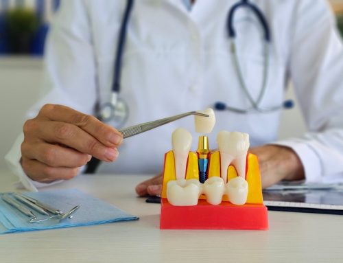 Why Dental Implants are a Gold Standard for Tooth Replacement