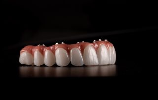 What If I Do Not Want to Replace All My Teeth on the Arch?