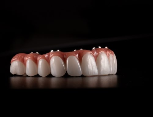 What If I Do Not Want to Replace All My Teeth on the Arch?