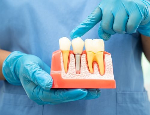 How Dental Implants Impact My Overall Health