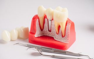 How Long Do All-On-4 Dental Implants Last