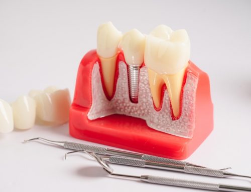 How Long Do All-On-4 Dental Implants Last