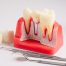 How Long Do All-On-4 Dental Implants Last