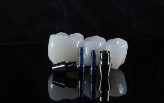 Understanding the Materials Used for All-On-4 Dental Implants