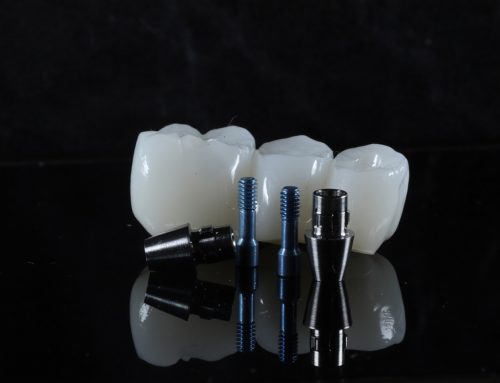 Understanding the Materials Used for All-On-4 Dental Implants