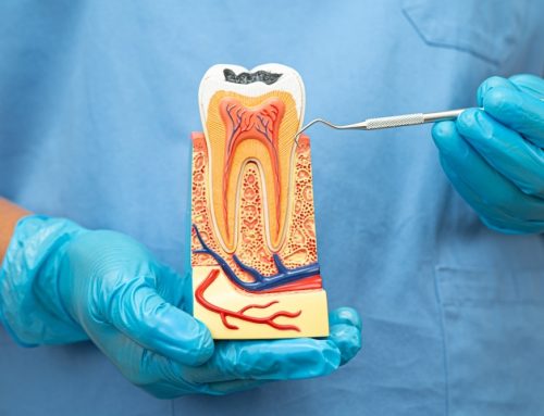 What Are the Benefits of Saving a Tooth with a Root Canal