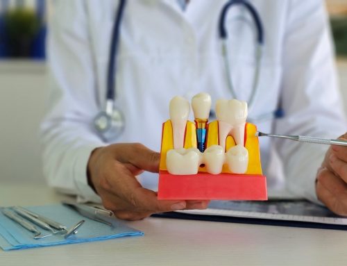 Why Dental Implants Are a Gold Standard for Tooth Replacement