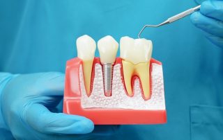 How Dental Implants Improve Your Confidence and Quality of Life