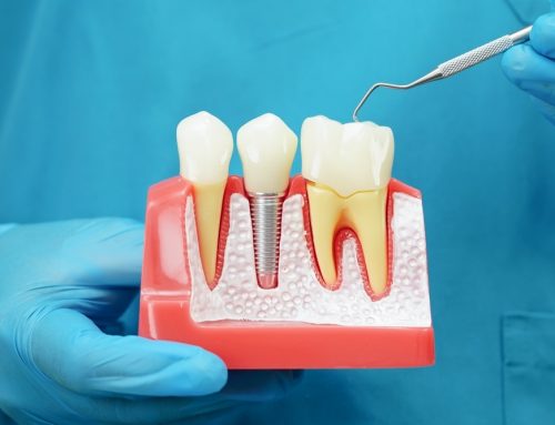 How Dental Implants Improve Your Confidence and Quality of Life