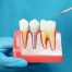 How Dental Implants Improve Your Confidence and Quality of Life