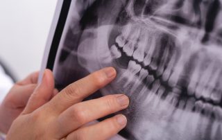 Why Dental Implants Are the Most Permanent Solution for Missing Teeth