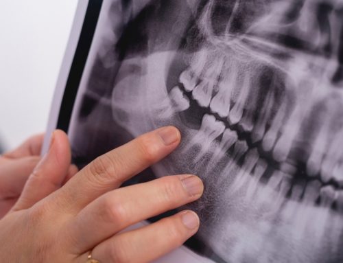 Why Dental Implants Are the Most Permanent Solution for Missing Teeth