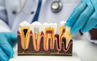 How Do Root Canals Save Your Natural Teeth?