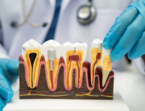 How Do Root Canals Save Your Natural Teeth?