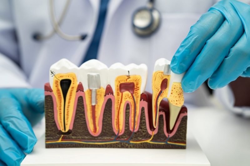 How Do Root Canals Save Your Natural Teeth?