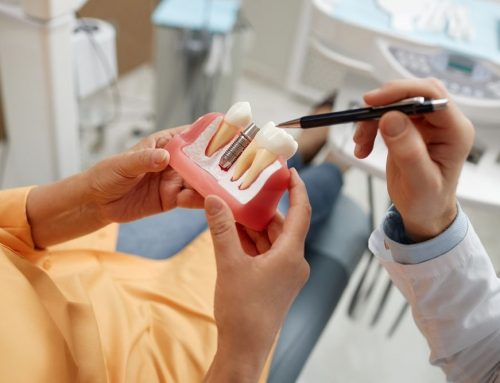 Why Are Dental Implants Considered the Best Tooth Replacement Option?