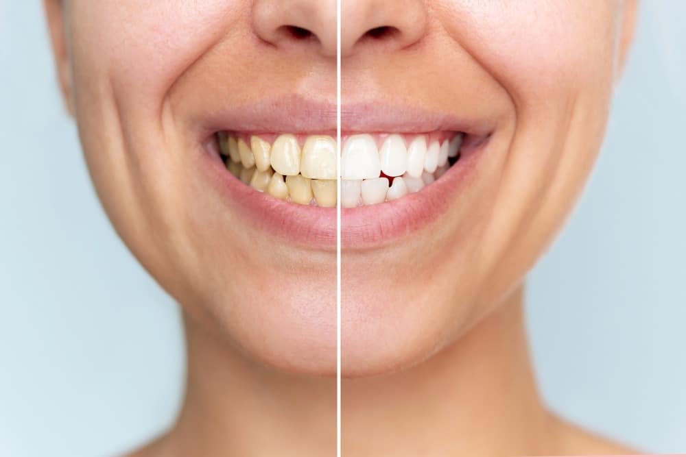 How Professional Teeth Whitening Delivers Faster Brighter Results Than Over the Counter Options