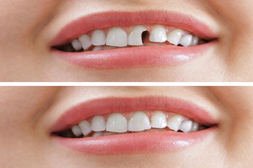 When Emergency Dental Care Is the Right Move for Toothaches, Cracked Teeth and Knocked Out Teeth