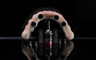 All-on-4 Dental Implants: A Full Smile Solution Explained