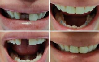 How Long Do Dental Implants Last