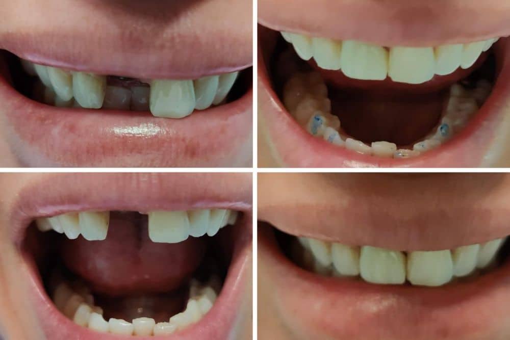 How Long Do Dental Implants Last