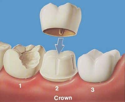 Dental Crowns