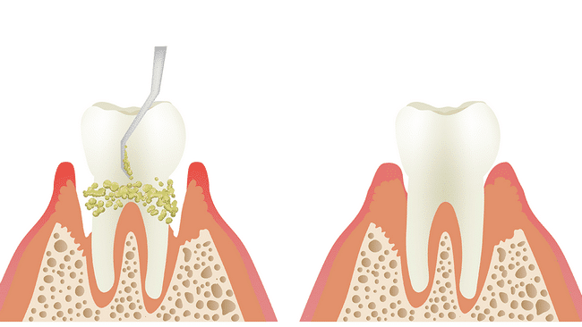 Scaling and root planning