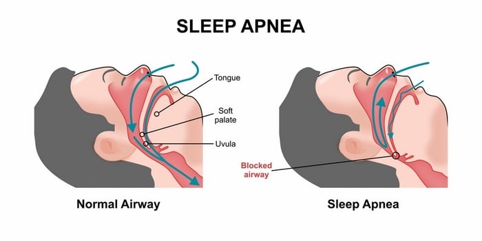 Sleep Apnea