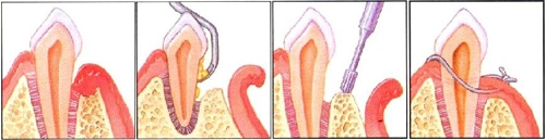 OSSEOUS SURGERY/POCKET REDUCTION
