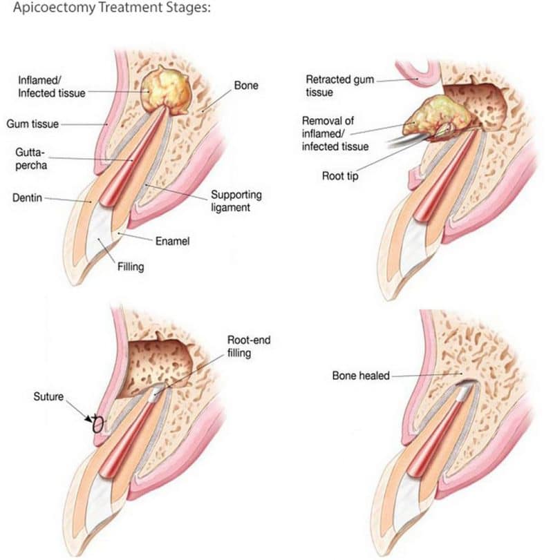 APICOECTOMY (ENDODONTIC SURGERY)
