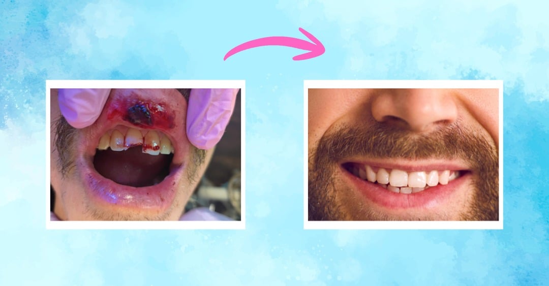 When Life Gets Messy: A Friendly Guide to Dental Trauma and How We Fix It