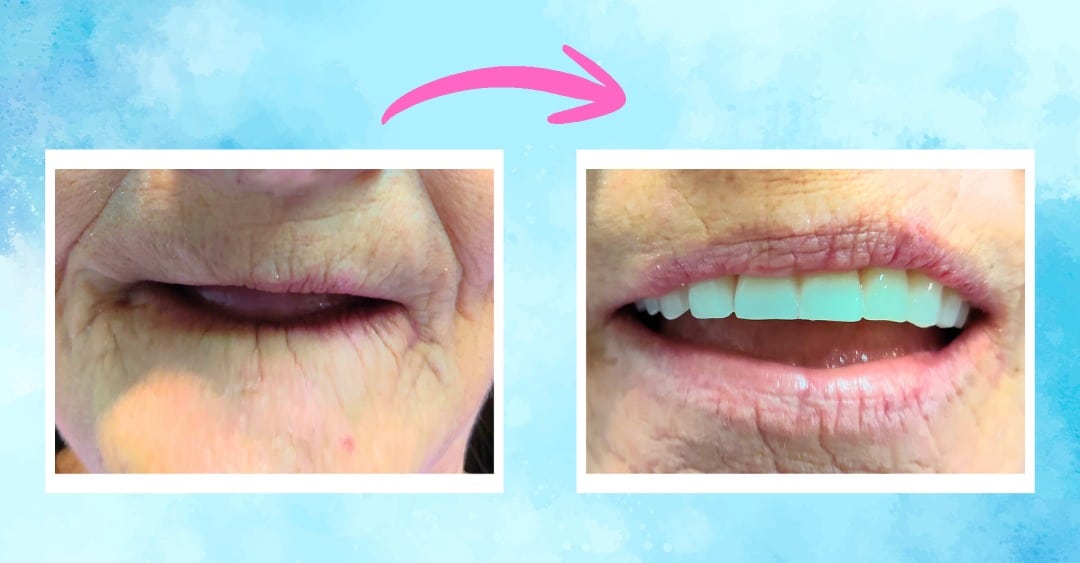 Full Mouth Extractions with 8 Implants and Snap-On Dentures