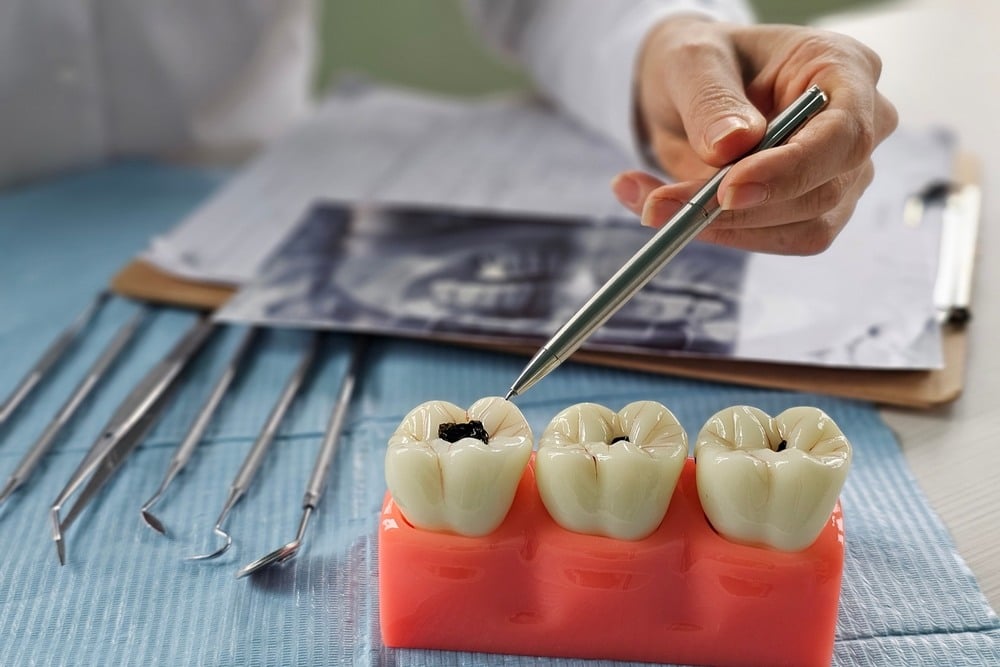 What Happens If You Ignore a Small Cavity