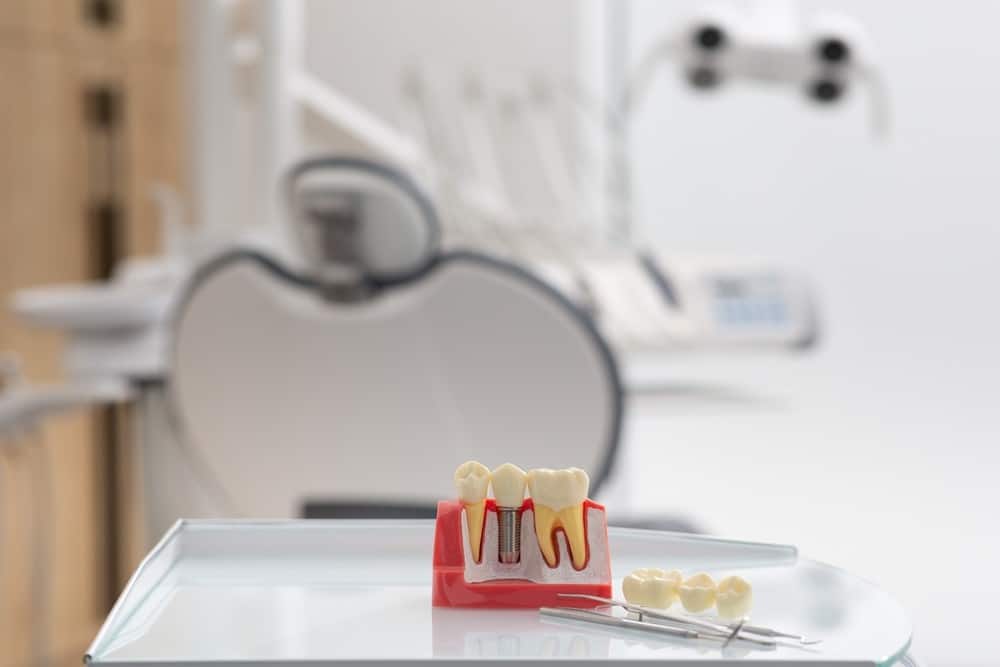 What to Expect During the Dental Implant Process