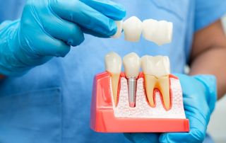 Why Missing Teeth Should Be Replaced With Dental Implants