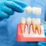 Why Missing Teeth Should Be Replaced With Dental Implants